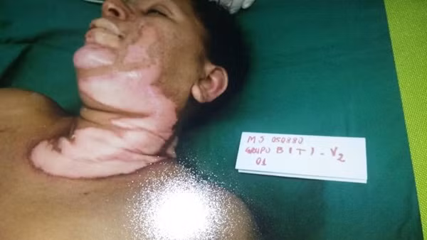 Người phụ nữ được chữa bỏng bằng da cá rô phi ảnh 2