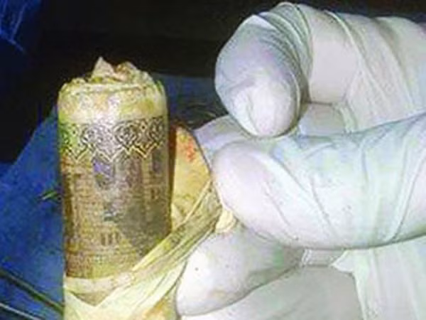 Bọc tiền trong bụng bệnh nhân ảnh 1