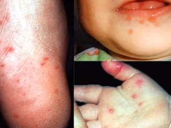 Bệnh tay chân miệng ở trẻ em: Không thể chủ quan ảnh 1