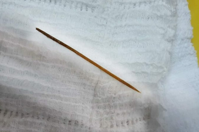 Ngủ quên, người đàn ông nuốt que tăm nhọn vào bụng ảnh 2 Ngủ quên, người đàn ông nuốt que tăm nhọn vào bụng ảnh 2