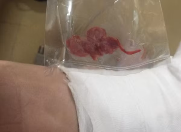 Để quên gạc trong chân bệnh nhân sau khi phẫu thuật, bác sĩ bị tạm đình chỉ ảnh 1