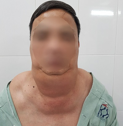 Cổ người đàn ông ở Hà Nội bị biến dạng kỳ dị vì uống 1 lít rượu mỗi ngày ảnh 1