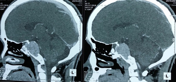Kỳ tích: Bệnh nhân u não được phẫu thuật nội soi bóc khối u qua mũi ​ ảnh 1