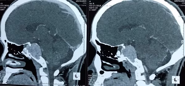 Kỳ tích: Bệnh nhân u não được phẫu thuật nội soi bóc khối u qua mũi ​ ảnh 1