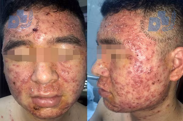 Dùng thuốc trị mụn mua trên facebook, nam thanh niên nhập viện với gương mặt gây kinh hãi ảnh 1