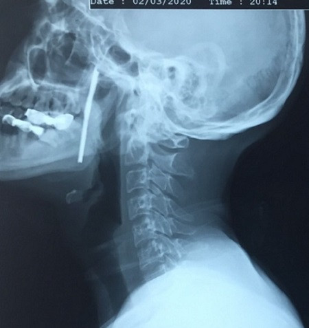 Bị thanh sắt nhọn bắn xuyên cổ, người đàn ông may mắn được cứu sống ảnh 1