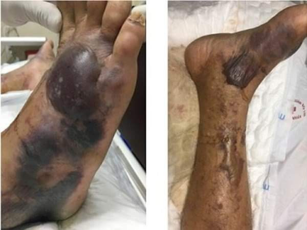 Người đàn ông tử vong do nhiễm khuẩn "ăn thịt" sống ký sinh trong hàu biển ảnh 1