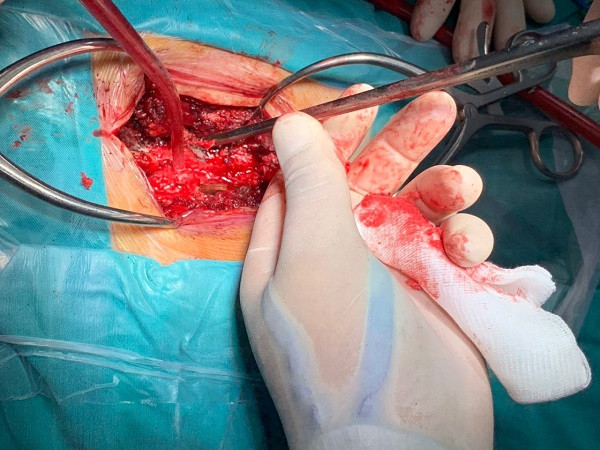 Mâu thuẫn trong đám cưới, nam thanh niên cầm que xiên thịt đâm bạn xuyên tủy sống ảnh 1