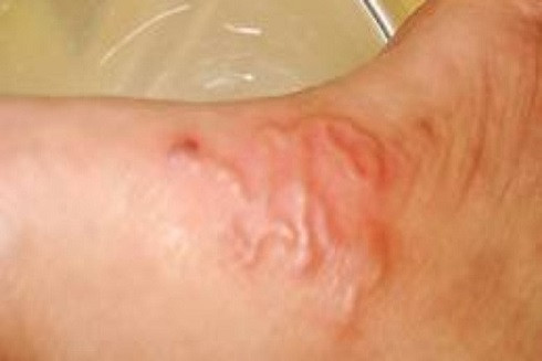 Nhiễm ấu trùng sán lợn: Nguy hiểm khôn lường ảnh 3