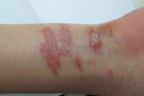 Vào "mùa" kiến ba khoang: Vết cắn giản đơn cũng có thể gây biến chứng ảnh 3