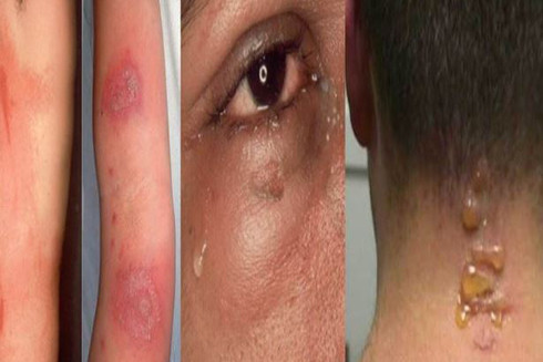 Vào "mùa" kiến ba khoang: Vết cắn giản đơn cũng có thể gây biến chứng ảnh 2