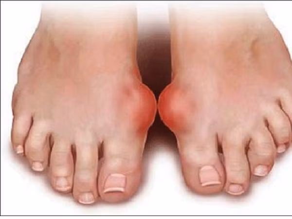 Bệnh gút có thể làm tăng nguy cơ tiểu đường ảnh 1