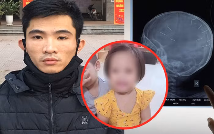 Bé gái ở huyện Thạch Thất bị đóng đinh vào đầu Bé gái ở huyện Thạch Thất bị đóng đinh vào đầu