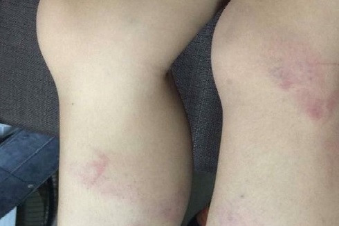 Những vết bầm tím trên chân nam sinh do bị cô giáo vụt bằng thước