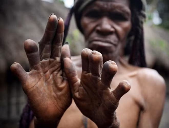 Bộ lạc Dani - Indonesia ngày nay vẫn lưu giữ nghi thức kỳ lạIkipalin - phong tục truyền thống cắt phần đầu ngón tay để xua đuổi tà ma khi người thân mất