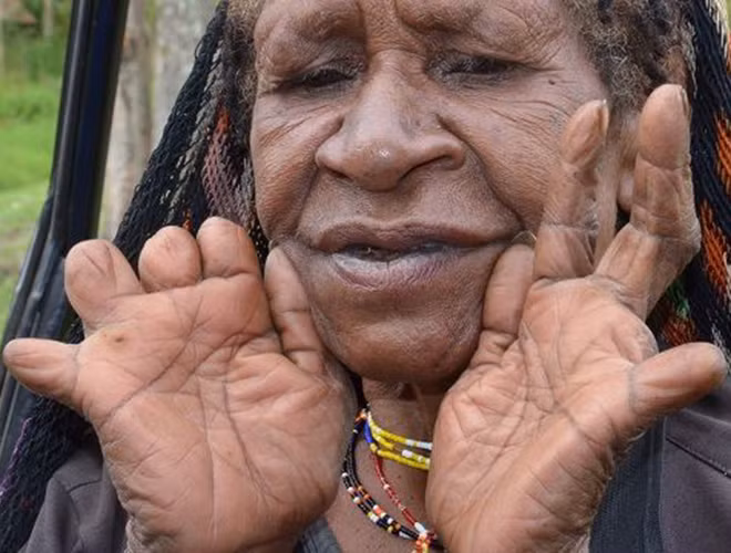 Nghi thức này đã bị chính phủ Indonesia cấm cách đây vài năm do phương thức tiến hành quá đáng sợ và bạo lực, tuy nhiên nhiều người phụ nữ vẫn bí mật thực hiện hủ tục này