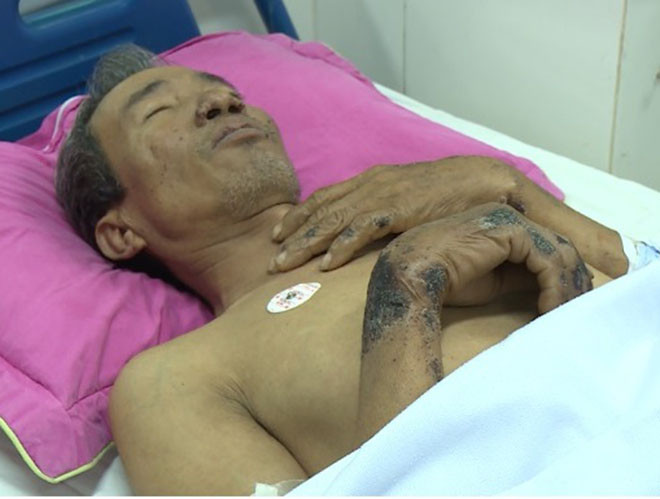 Người đàn ông 60 tuổi này hiện đang điều trị tại Bệnh viện Nhiệt đới Trung ương và được chẩn đoán là nhiễm khuẩn huyết do liên cầu khuẩn lợn