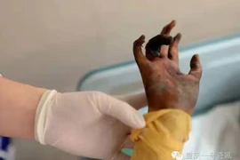 Bé gái bỏng 80% cơ thể vì cứu bố