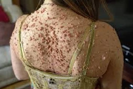 Chi chít gần 6.000 nốt mụn thịt khắp người