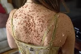 Chi chít gần 6.000 nốt mụn thịt khắp người