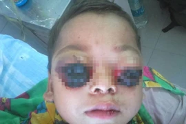 Bi kịch đau lòng của bé trai 3 tuổi có đôi mắt ếch đỏ ngầu