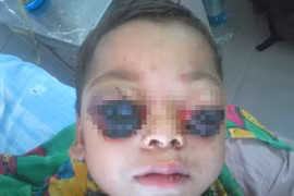 Bi kịch đau lòng của bé trai 3 tuổi có đôi mắt ếch đỏ ngầu