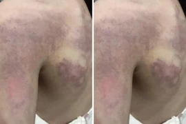 Cô giáo dùng thước đánh bầm lưng học sinh vì không thuộc bài 