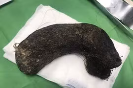 Hi hữu: Phẫu thuật lấy búi tóc nặng 1kg trong dạ dày bé gái 11 tuổi