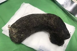Hi hữu: Phẫu thuật lấy búi tóc nặng 1kg trong dạ dày bé gái 11 tuổi