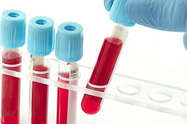 Kiểm tra máu dự đoán nguy cơ đột quỵ