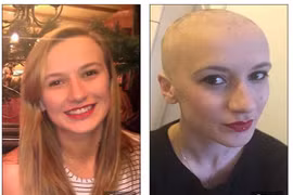 Rụng hết tóc vì quá căng thẳng