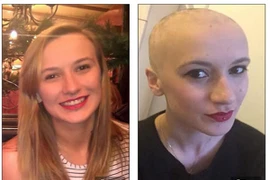 Rụng hết tóc vì quá căng thẳng