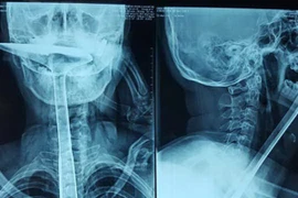 Dại dột dùng xẻng nấu ăn thông họng