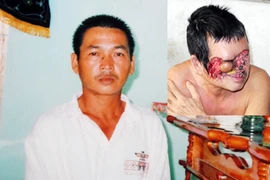 Biến dạng mặt vì… tẩy nốt ruồi