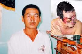 Biến dạng mặt vì… tẩy nốt ruồi