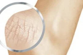 Xử lý nứt gót chân