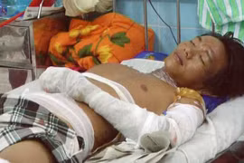 Nổ bồn xăng, 2 người bị thương nặng
