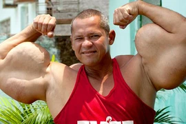 Phát sợ khi xem bắp tay dị dạng, khổng lồ