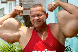 Phát sợ khi xem bắp tay dị dạng, khổng lồ