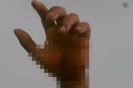 Kịp ngâm đá lạnh, cánh tay đứt lìa được ráp nối