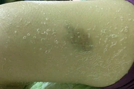 Tắm trắng tại nhà, cô gái bị "lột da" loang lổ toàn thân