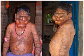 Cậu bé Ấn Độ khốn khổ vì bị hàng trăm khối u nổi trên cơ thể