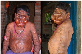 Cậu bé Ấn Độ khốn khổ vì bị hàng trăm khối u nổi trên cơ thể