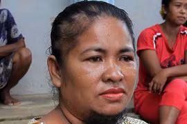 Người phụ nữ mọc râu và lông ngực bất thường như đàn ông