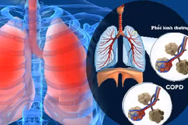 Những bệnh lý nguy hại về phổi
