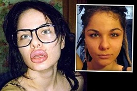 Kinh hoàng đôi môi sưng vù sau 100 lần tiêm