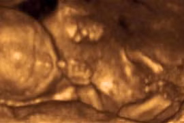 Mẹ “quá cân” sẽ khiến con phát phì