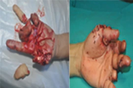 Nối ngón tay bằng kỹ thuật vi phẫu 