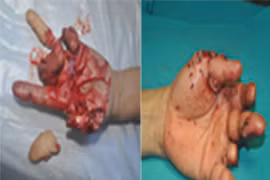 Nối ngón tay bằng kỹ thuật vi phẫu 