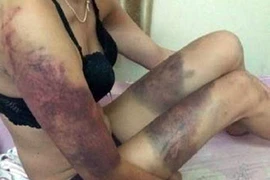 Cơ quan Công an đang điều tra vụ cô gái bị người tình đánh thâm tím cơ thể